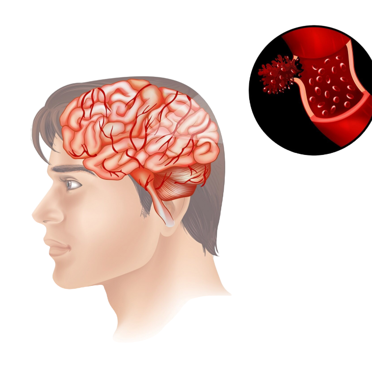 Gambar: Kenapa Bisa Pembuluh Darah Pecah di Otak?